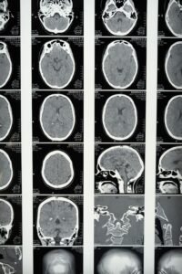 Conjunto de resonancias magnéticas cerebrales mostrando la anatomía craneal, ilustrando el desarrollo del cerebro adolescente