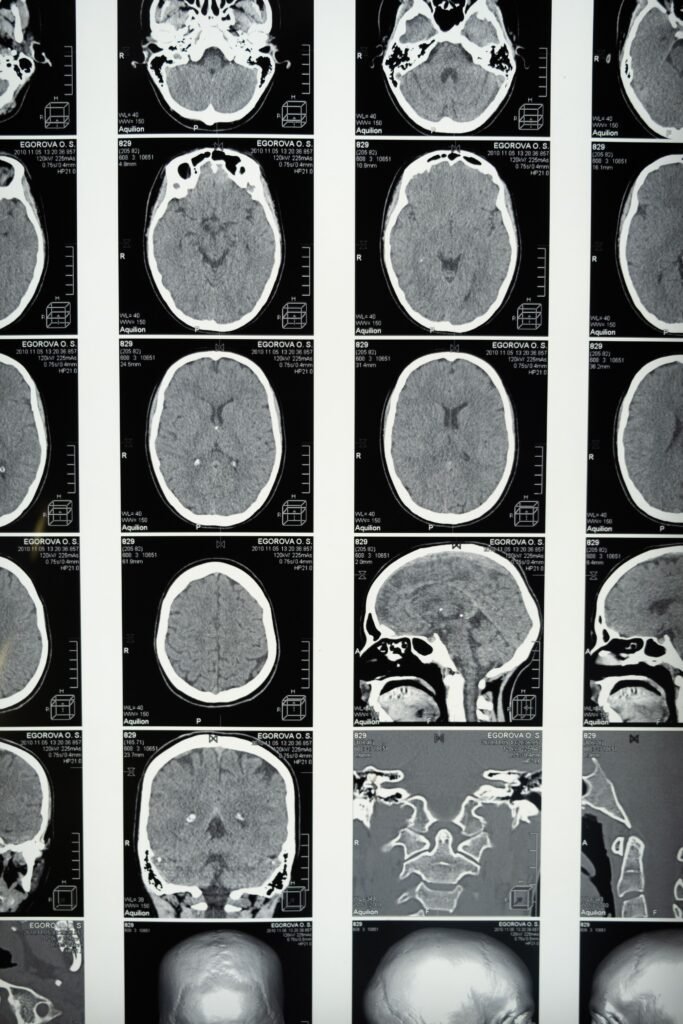 Conjunto de resonancias magnéticas cerebrales mostrando la anatomía craneal, ilustrando el desarrollo del cerebro adolescente